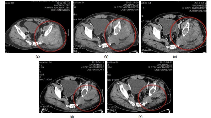Tratamiento Oncothermia Sarcoma