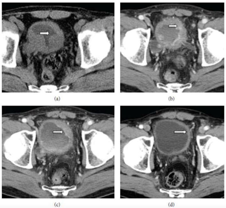 Tratamiento Oncothermia en Hospital Clifford